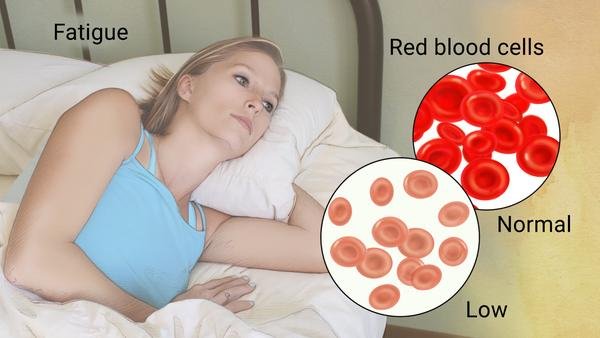 Anemia: Symptoms, Treatments, Types, And Causes