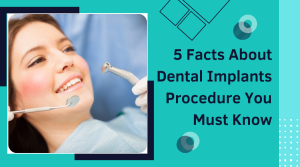 5 Facts About Dental Implants Procedure You Must Know