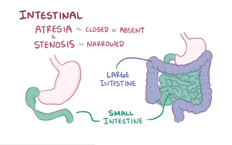 What are the classes of neonatal intestinal atresias?